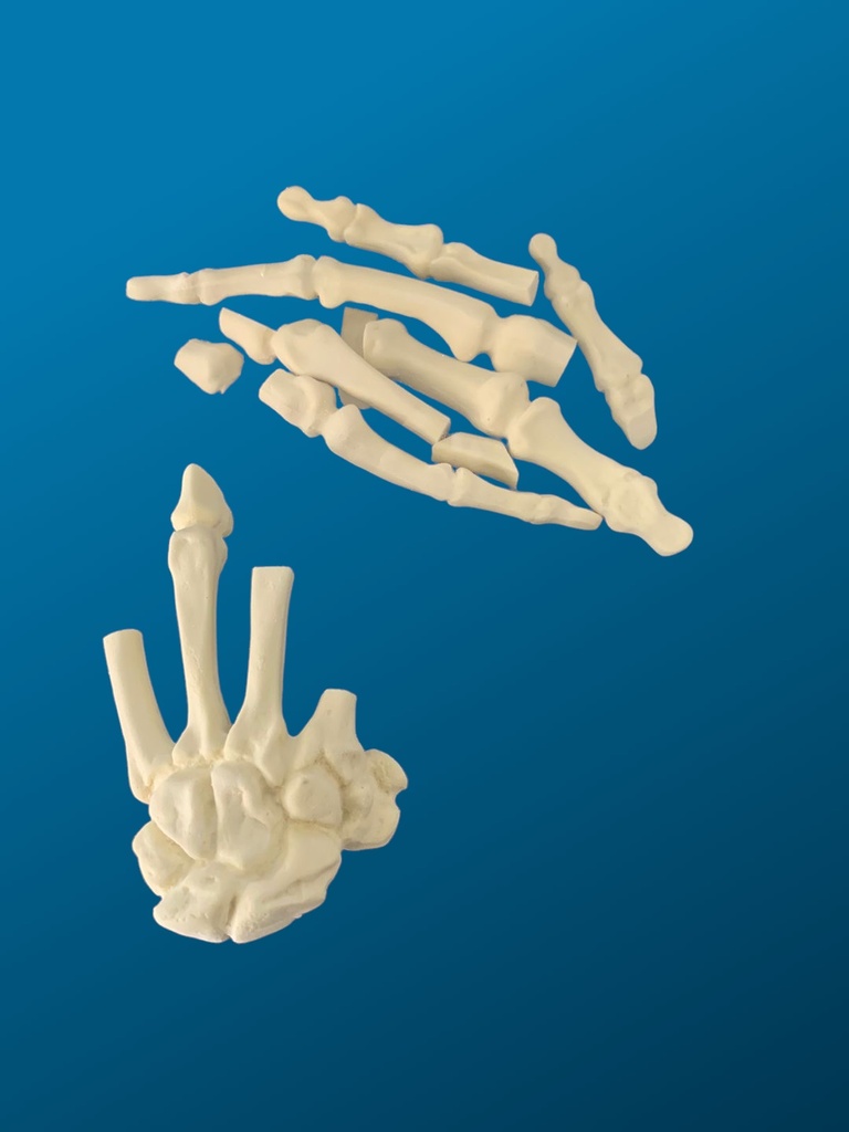 [1124] Mano con falanges fracturadas