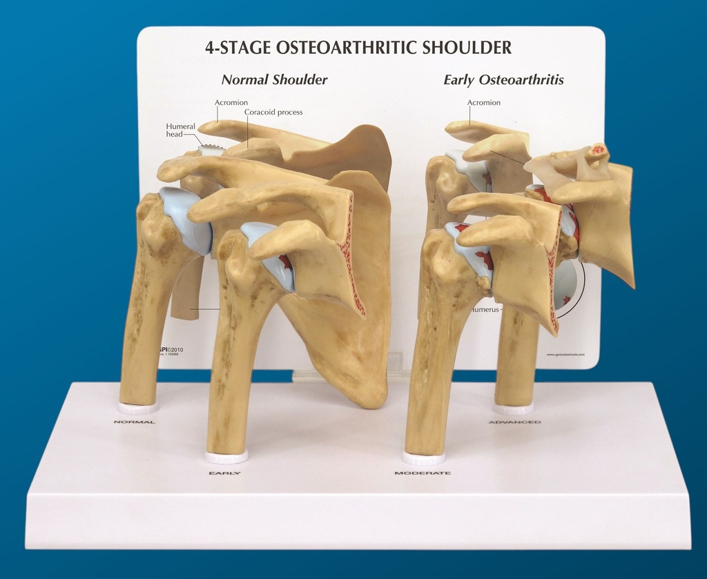 [1612] Osteoartritis de hombro en 4 etapas