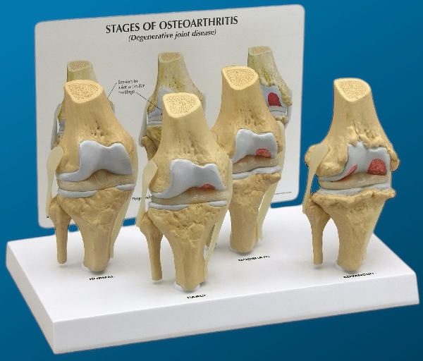 [1613] Osteoartritis de rodilla en 4 etapas