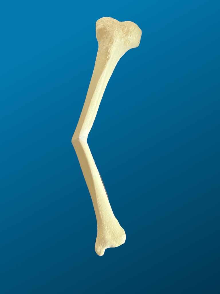 [1223] Tibia con mala consolidación de la diáfisis y defecto en varo de 25 grados