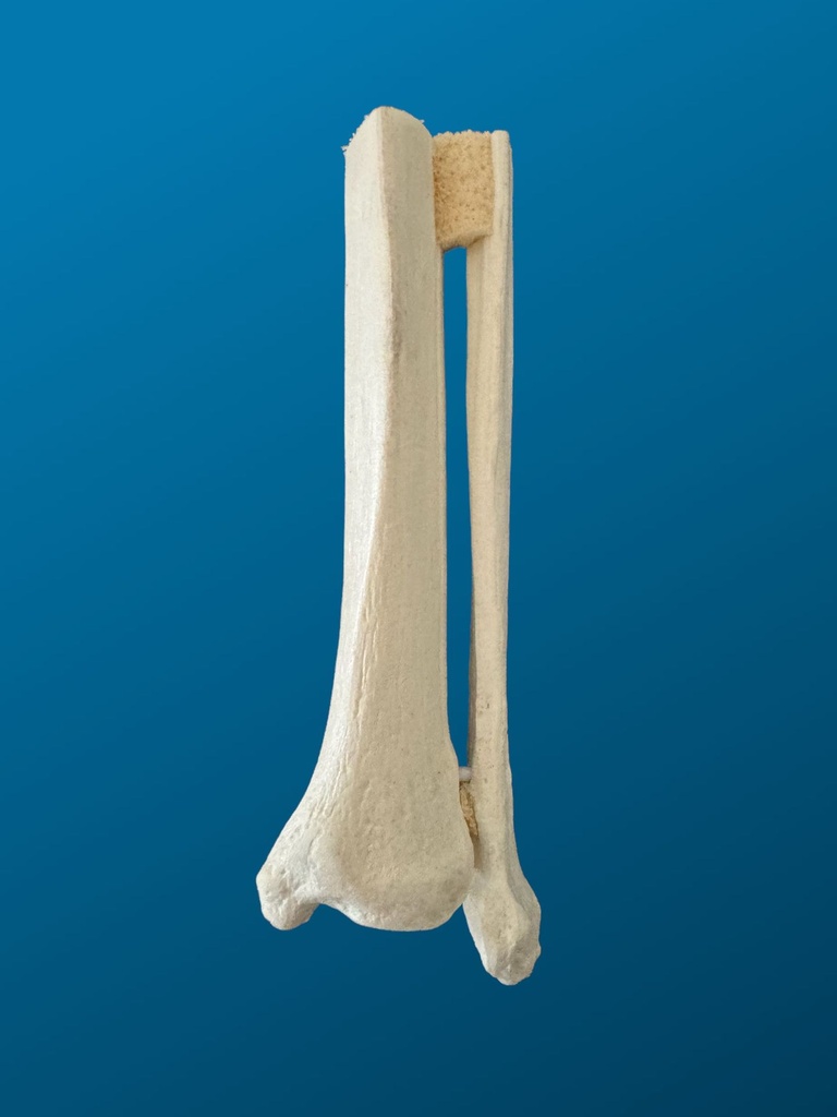 [1158] Tibia y peroné, distal, espuma solida, izquierdo