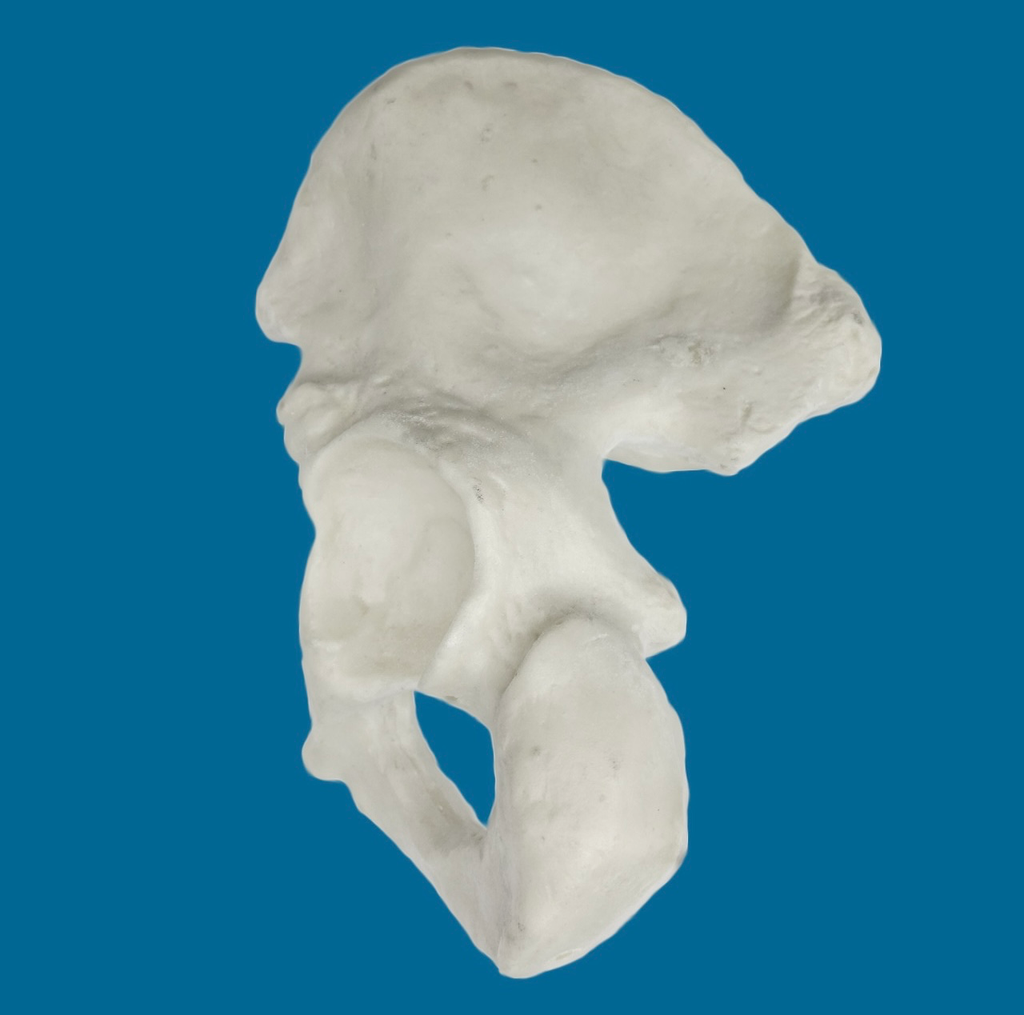[1110] Hemipelvis con acetábulo de 57 mm, izquierdo
