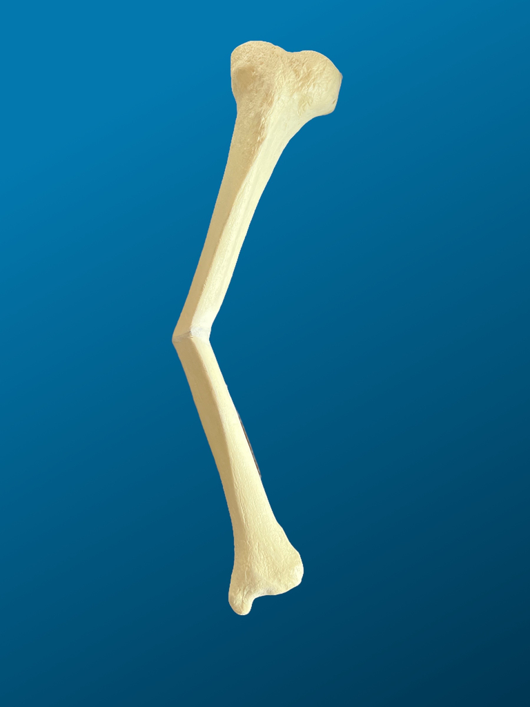 Tibia con mala consolidación de la diáfisis y defecto en varo de 25 grados